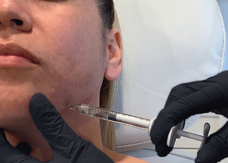 Microneedle RF: A Game-Changer in Cosmetic Treatments